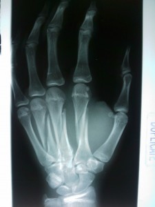 Left Hand, 3 Bones Broken