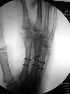 seven screws