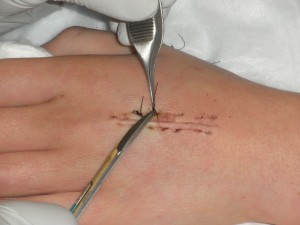 Stitch Removal