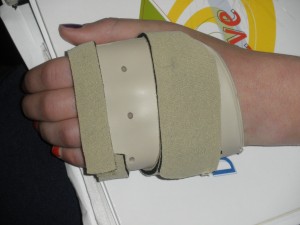Removable Splint