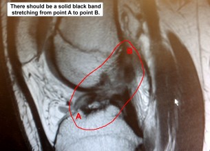 MRI ACL view